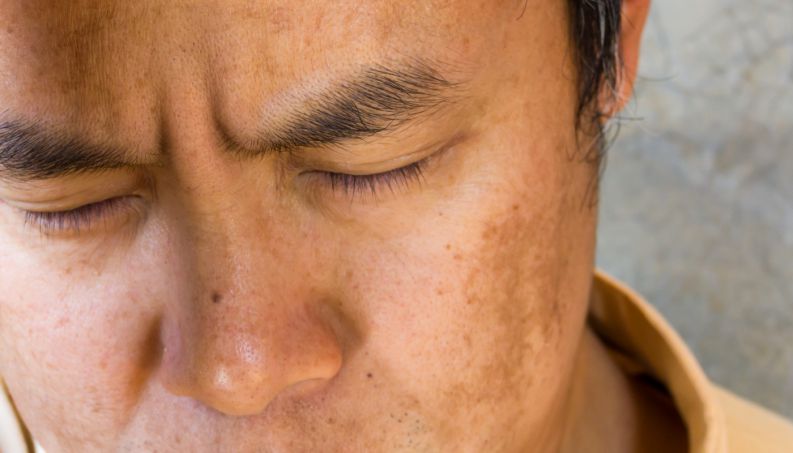 melasma