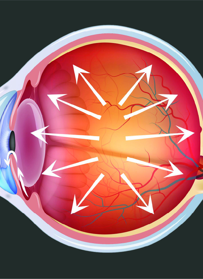 specialty-x-glaucoma