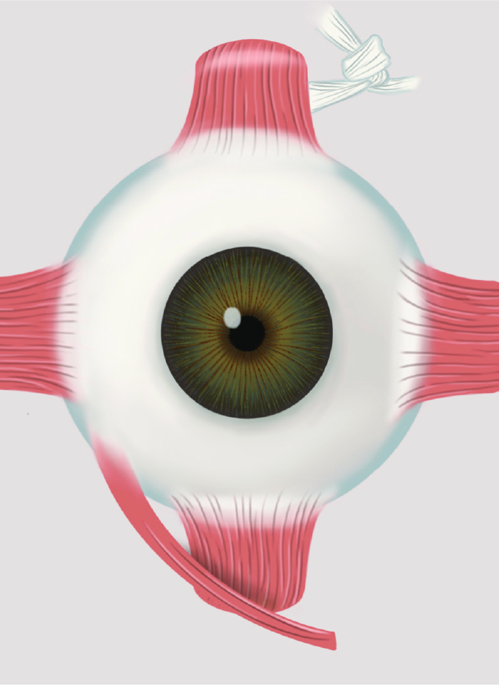 specialty-x-strabismus