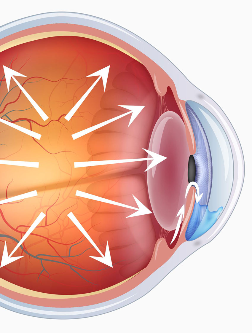 surgery-glaucoma